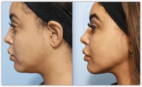 EMS Facial & Neck Lifting Massager for Wrinkle Reduction & Skin Tightening