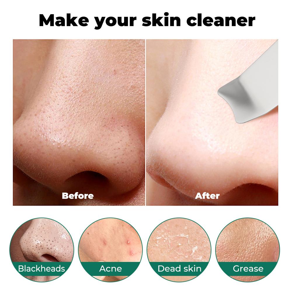 Ultrasonic Facial Cleanser & Scrubber