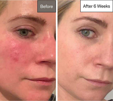 LED Red Light Therapy Face Mask